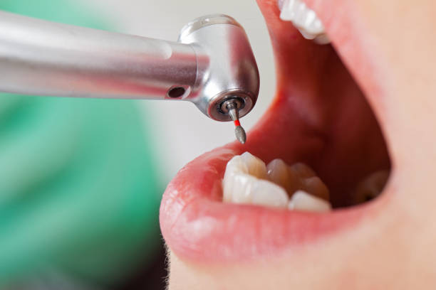 Best Emergency Broken Tooth Repair in Rden, WA